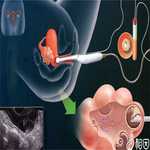 输卵管肿瘤能治好吗！输卵管肿瘤有什么症状！